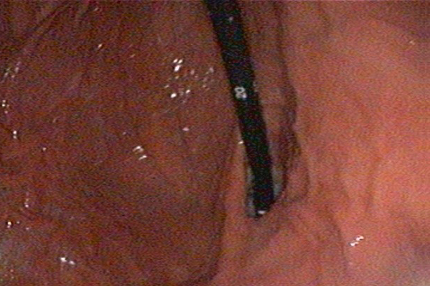 gastroduodenoscopia-stomaco-2