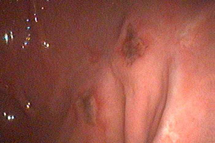 gastroduodenoscopia-stomaco-3