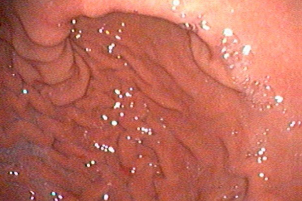 gastroduodenoscopia-stomaco